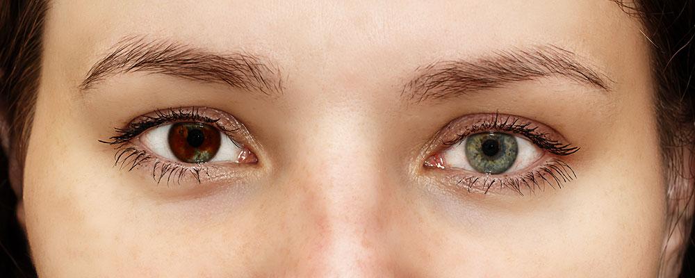 ¿Conoces a alguien que tenga un ojo de cada color?